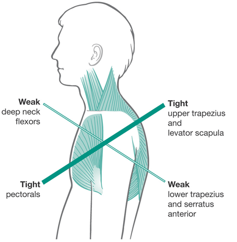 upper cross syndrome